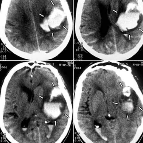 Accidentul vascular cerebral hemoragic